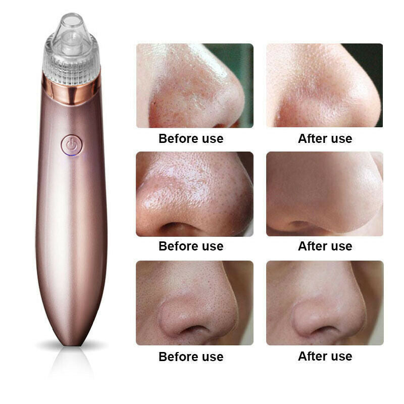 Electric Blackhead Vacuum Cleaner Pore Cleaner Acne Remover